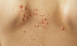 Çocuklarda ve Yetişkinlerde Molluscum Contagiosum Enfeksiyonuna Karşı Alınacak Önlemler